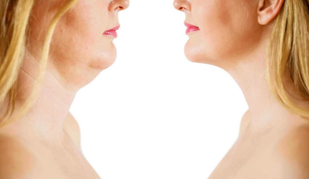 Double Chin treatment Wrexham before and after results