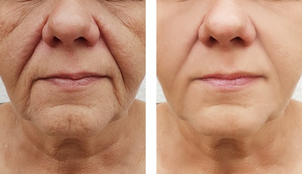 Learn more about Morpheus8 Treatment Wrexham today!