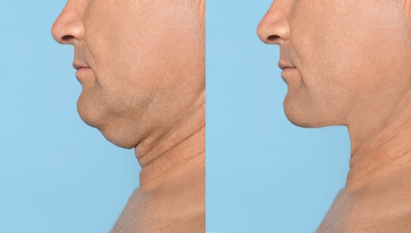 Which Non-Surgical Treatments Work Best for Jowls and Loose Skin Wrexham?