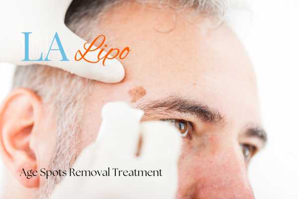 What Are the Most Effective Treatments for Age Spots Wrexham?