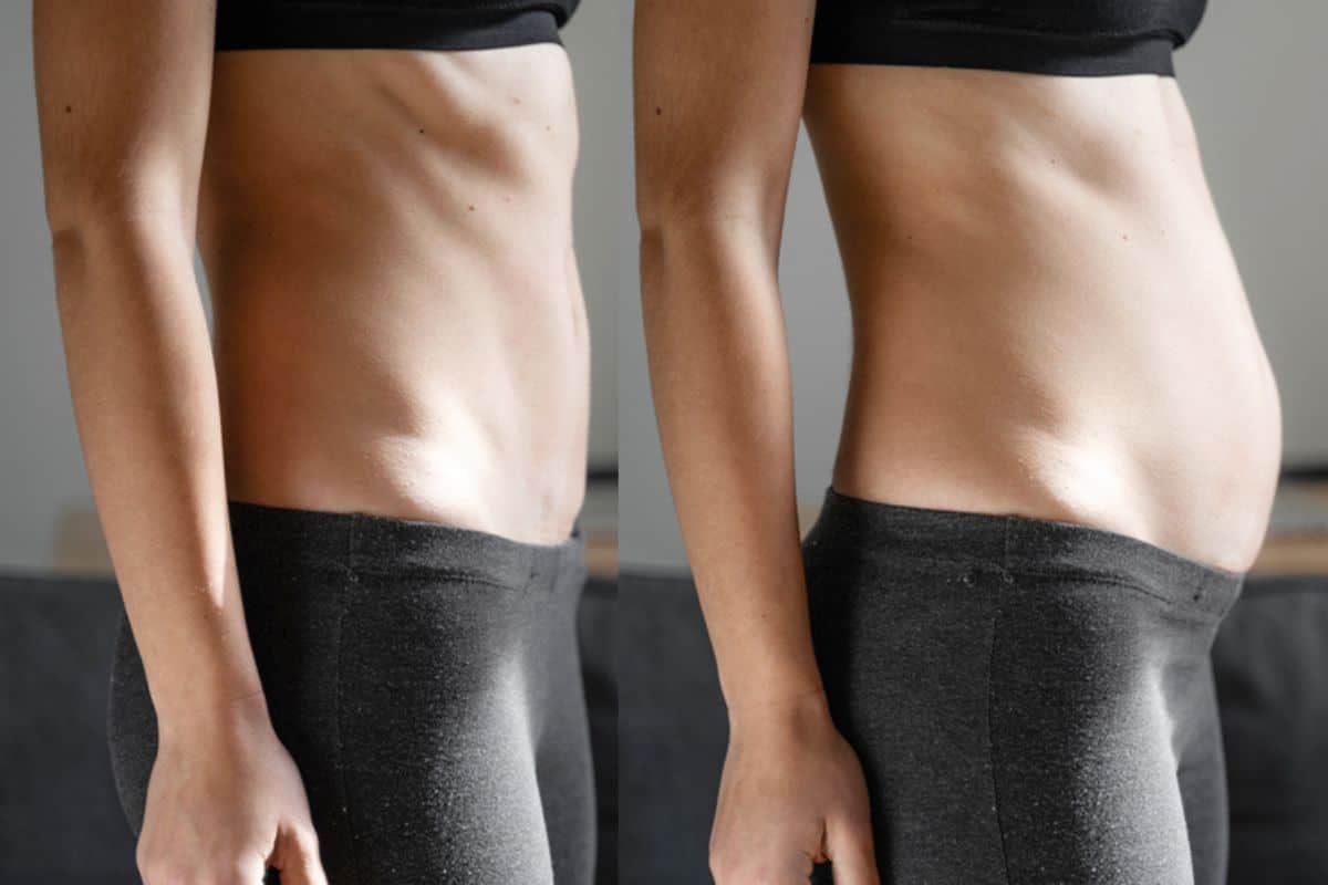 How long does diastasis recti take to improve Wrexham?