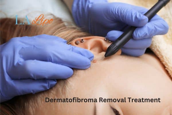 Dermatofibroma Removal Treatment Wrexham