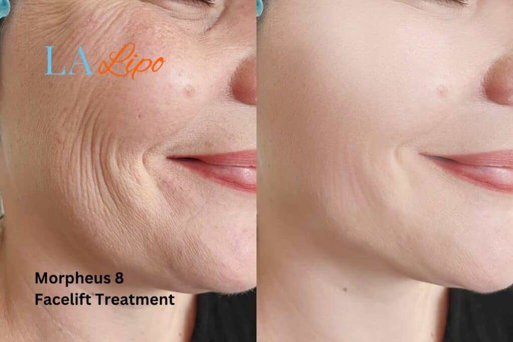 Morpheus8 Treatment Wrexham for flawless skin! Call us today!