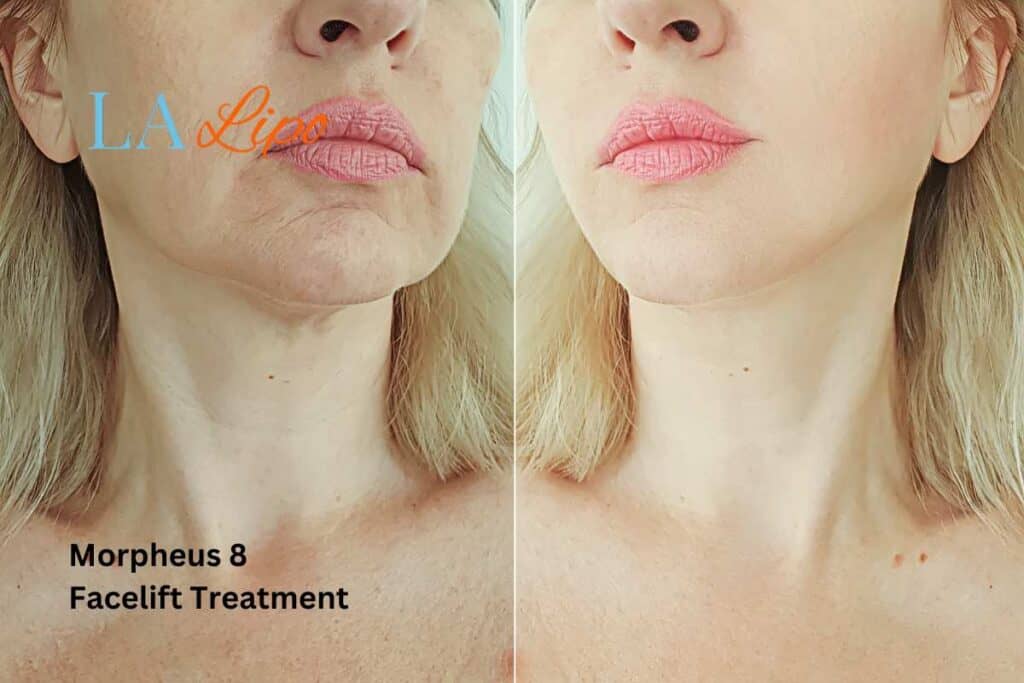Turn back time with Morpheus8 Treatment Wrexham