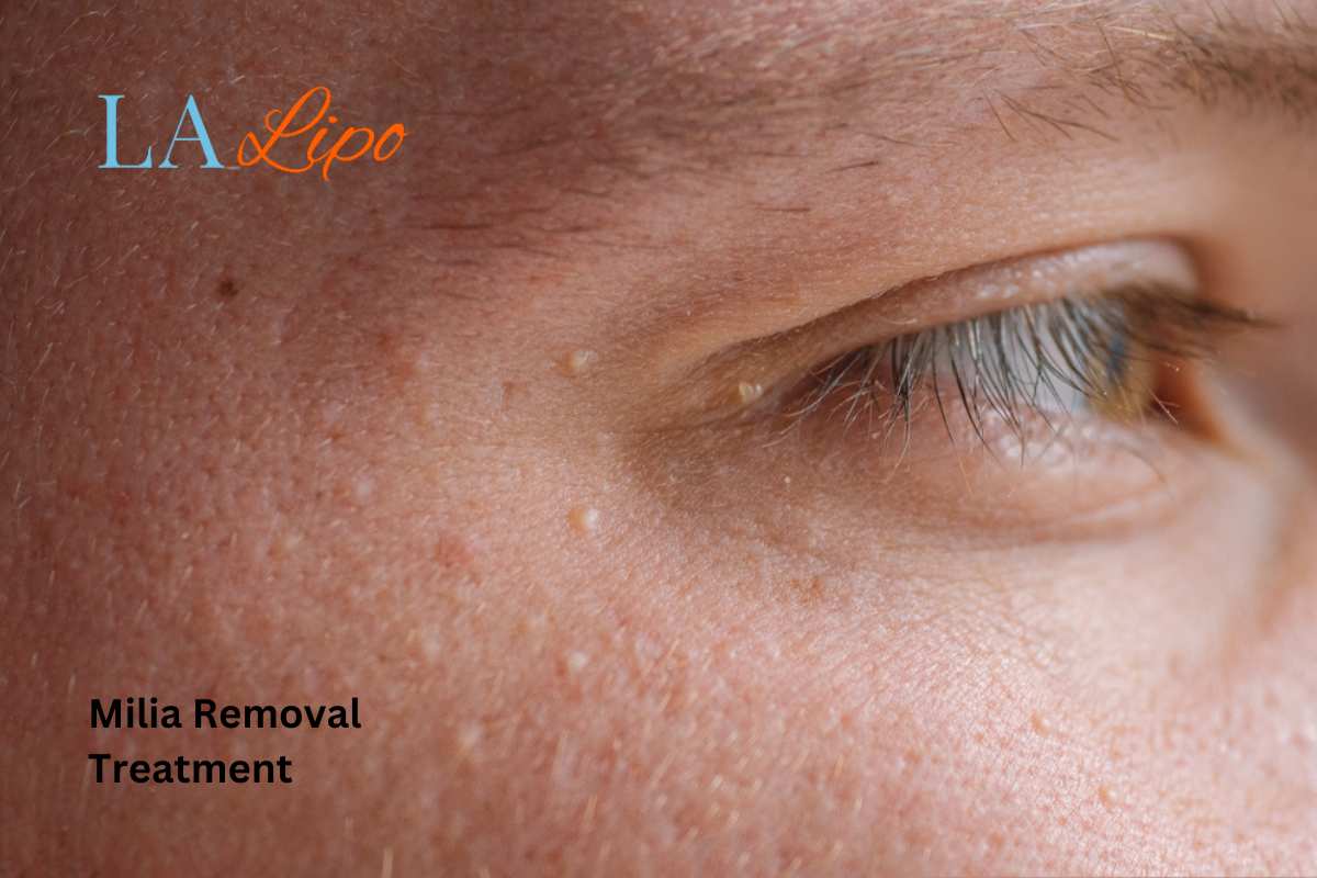Cryopen Milia Removal: Is It the Easiest and Safest Option Wrexham?