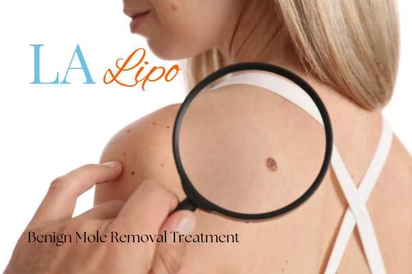 Woman having her inspection of blemish before mole removal Wrexham
