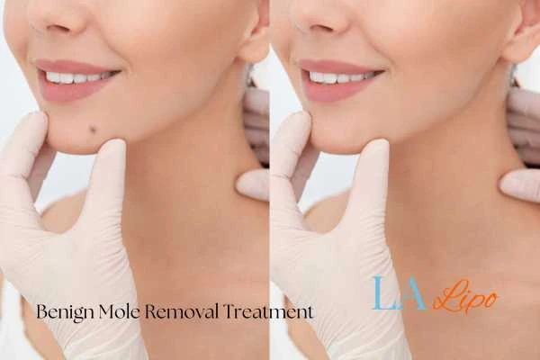 woman's before and after mole removal Wrexham results