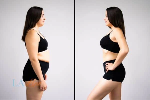 image of woman before and after results of LA-EMS Body Sculpting Wrexham to help treat Diastasis recti