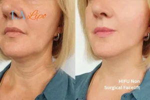 hi-fu for wrinkles Wrexham before and after results