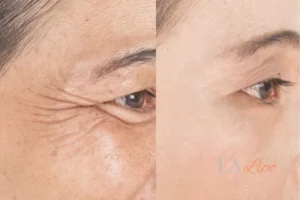 Before and after results of woman - HI-fu wrinkles reduction treatment Wrexham