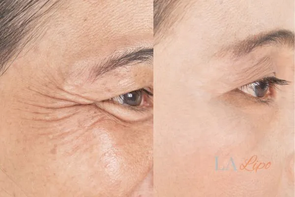 Before and after results of woman - HI-fu wrinkles reduction treatment Wrexham