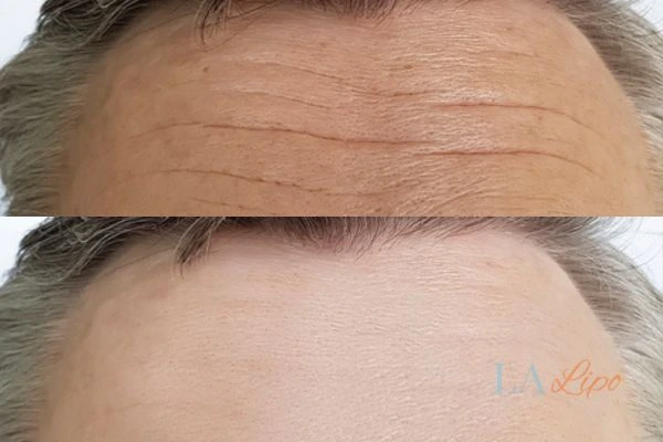 results of HIFU Wrexham on mans forehead to help reduce lines and wrinkles