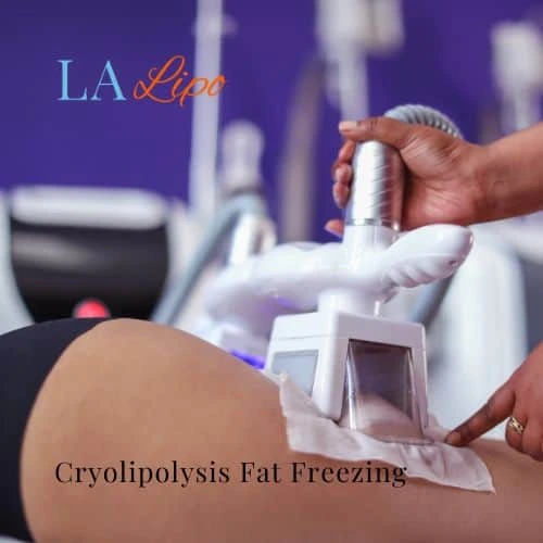 fat freezing - Cryolipolysis Wrexham