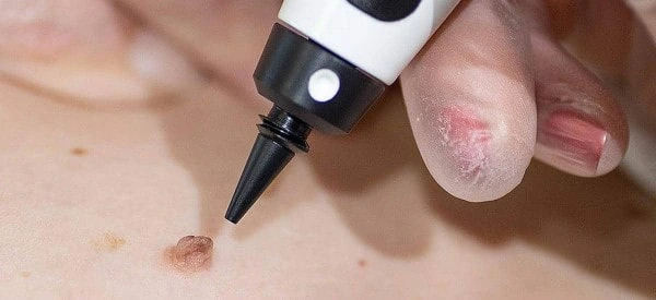 skin tag removal using cryopen Wrexham