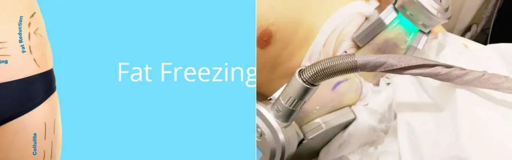 Fat freezing Wrexham on multiple areas of the body