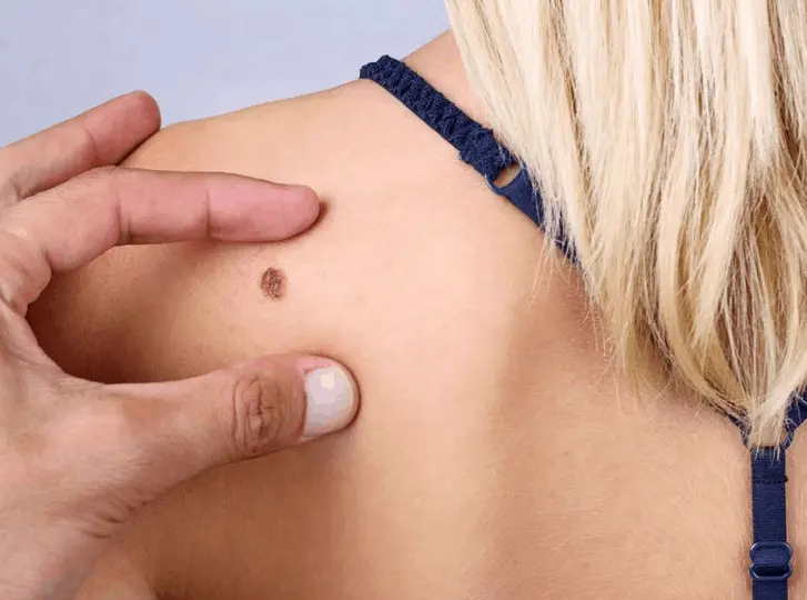woman having mole removal Wrexham consultation before treatment.