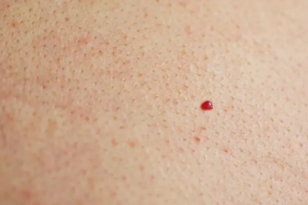 close up of a cherry angioma Wrexham
