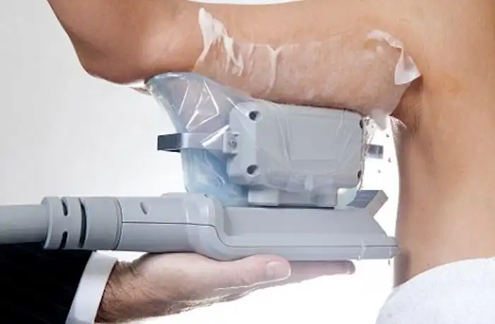 Picture of fat freezing Wrexham on the upper arms.