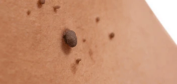 image of a skin tag Wrexham