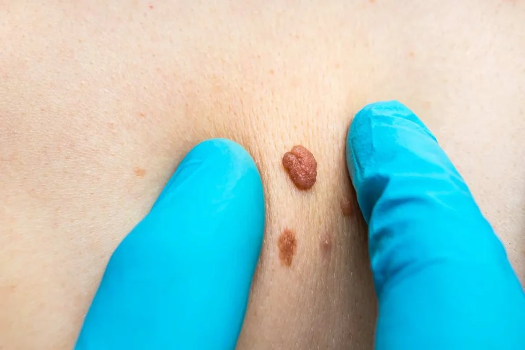 Consultant examining a skin tag Wrexham