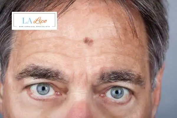 Solar Lentigo Removal Wrexham image of man with mark on his forehead