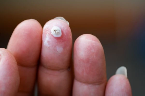wart on person finger - cryotherapy to treat from LA LIPO Wrexham