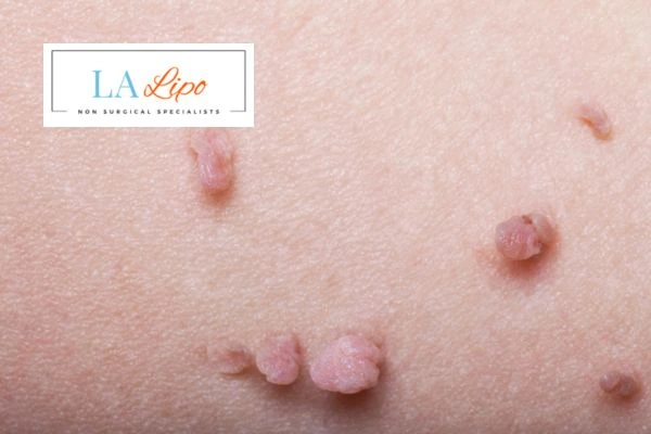 Does cryopen skin tag removal Wrexham hurt? Find out now call our team today!
