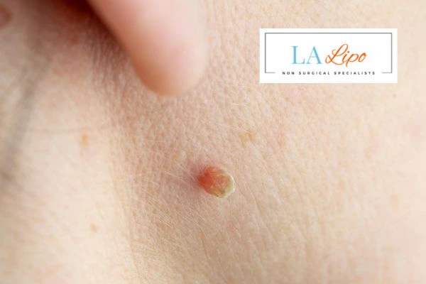 Book skin tag removal Wrexham today speak to our team now!