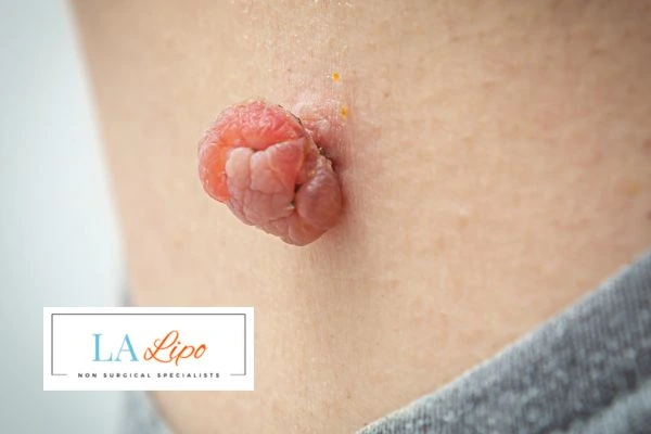 Interested in skin tag removal Wrexham? Concerned about the pain? Find out more today!
