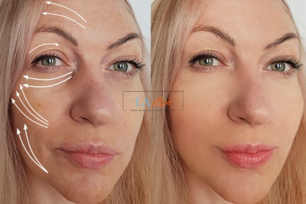 Morpheus 8 results Wrexham face lift.