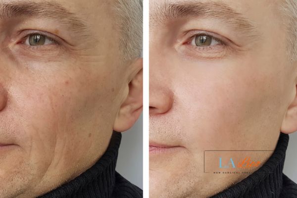 See the amazing results of Morpheus8 Treatment Wrexham!