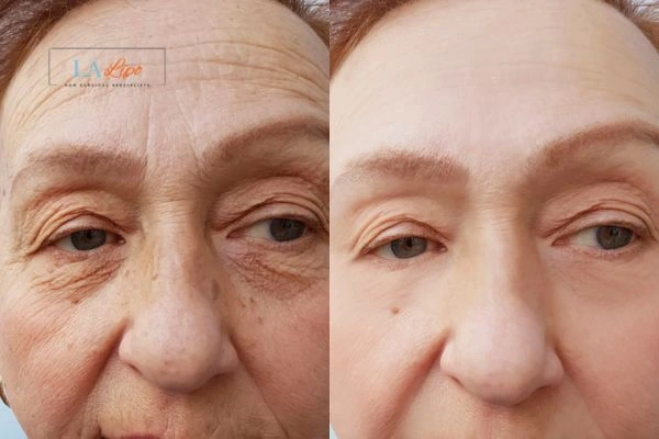 The powerful benefits of Morpheus8 Treatment Wrexham - Call Our team today!