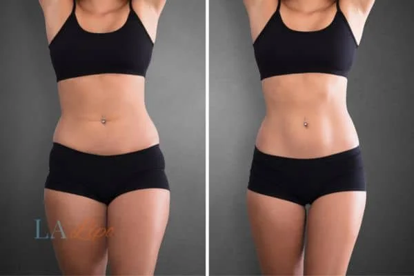 before and after results of non-surgical treatment to help a woman's body image and mental health Wrexham