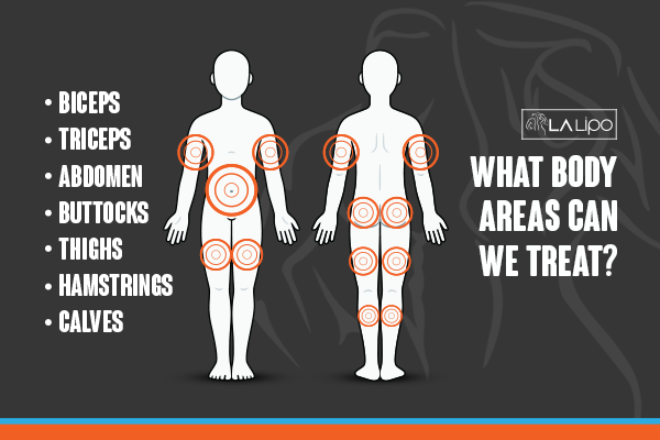 Diagram to show areas you can have LA-EMS Body Sculpting Treatment Wrexham