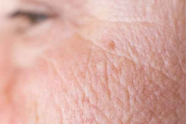 close up picture of a woman's face showing an age spot Wrexham
