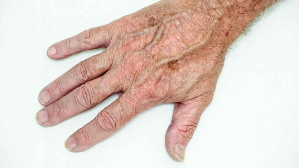 Male hand showing age spot Wrexham