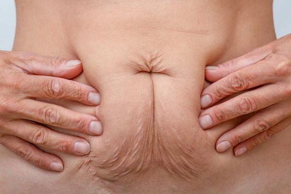 Image of a woman's stomach with loose skin - example of skin tightening Wrexham options