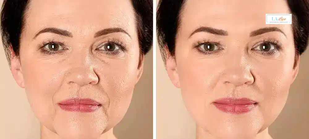 How Long Does It Take to See Results and How Long Do They Last Wrexham?