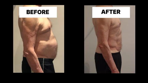What Symptoms Can Diastasis Recti Cause in Men? Weak Core, Back Pain and Poor Posture Wrexham